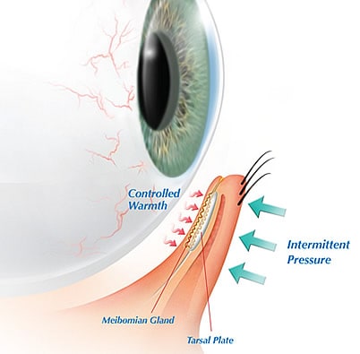 Dry Eye Syndrome Tampa Bay St Petersburg Clearwater FL